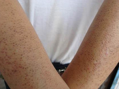 维生素a缺乏症胳膊上很多红点图