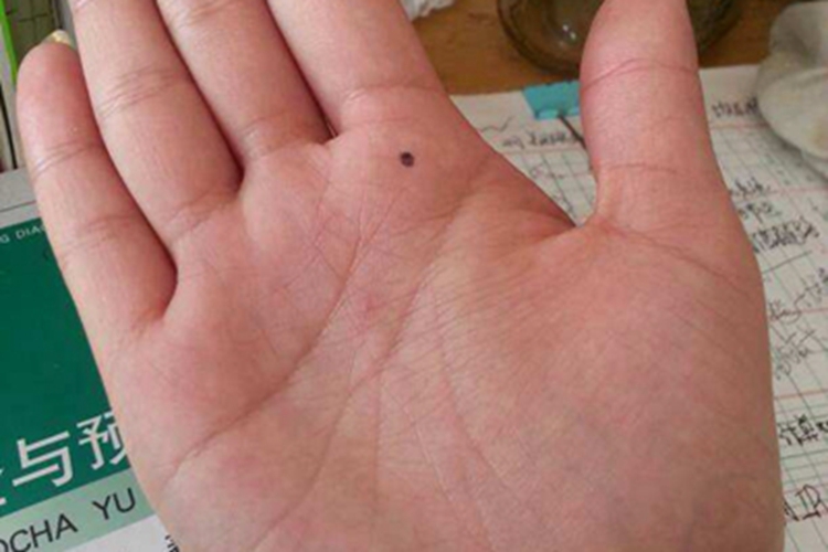 交界痣手掌有一个黑点图