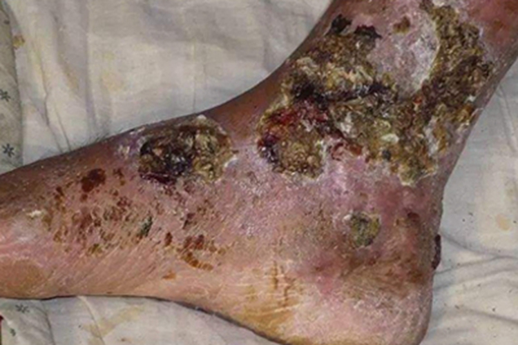 血栓闭塞性脉管炎脚部溃烂结痂图