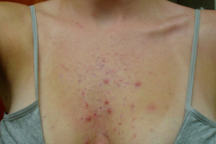 痤疮胸前红色小痘痘图