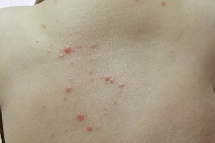 孩子10岁湿疹图