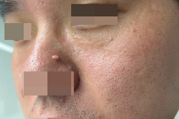 软纤维瘤小疙瘩图 软纤维瘤小疙瘩图