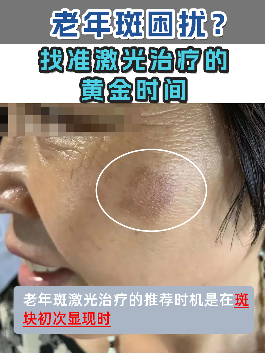 老年斑困扰?找准激光治疗的黄金时间