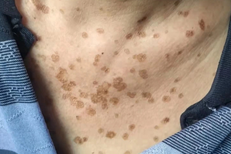 汗孔角化症胸部黑斑图