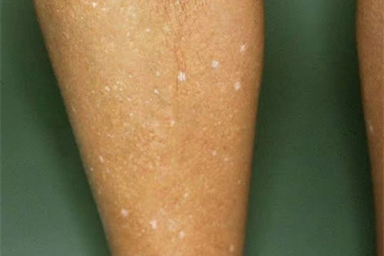 老年性点状白斑小腿有很多白点图