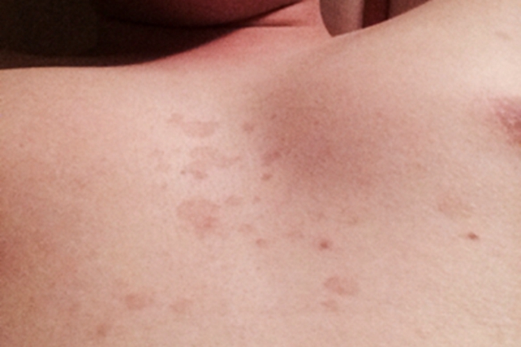 网状肢端色素沉着症状图 网状肢端色素沉着症状图