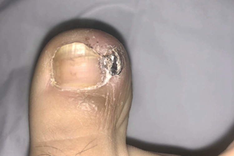 慢性甲沟炎脚趾甲发黑图