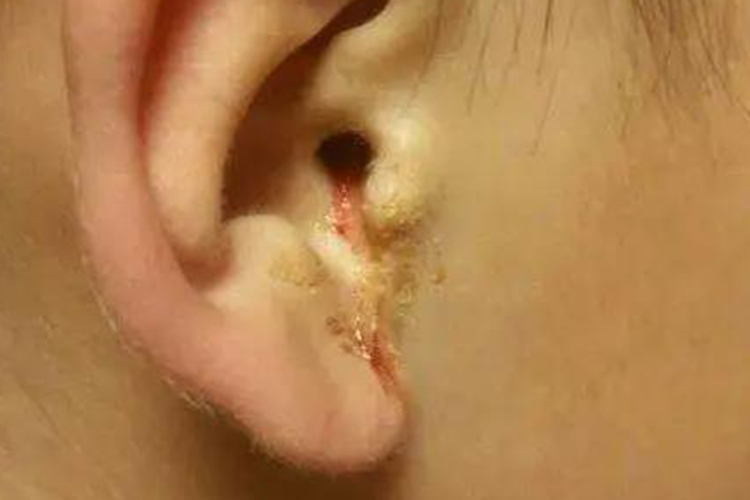 大疱性鼓膜炎血性渗出液图