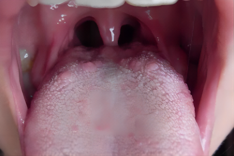 舌根增生图