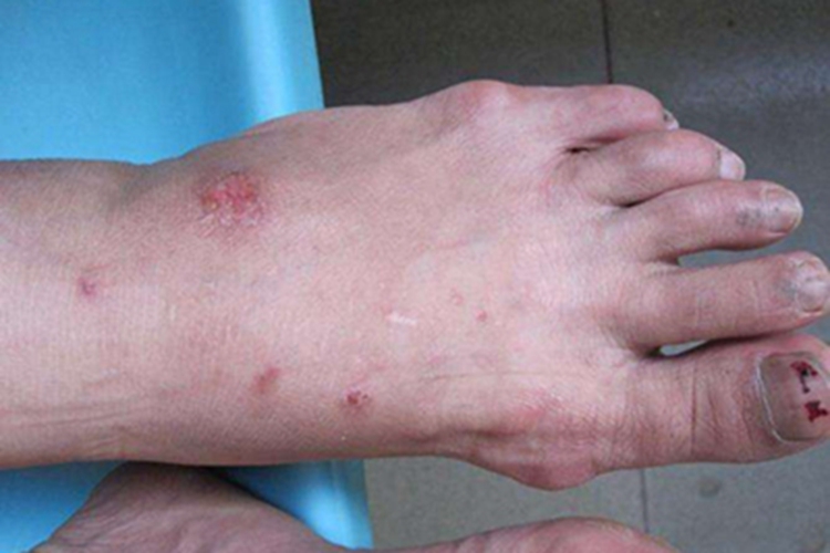 体虱病血痂图 体虱病血痂图