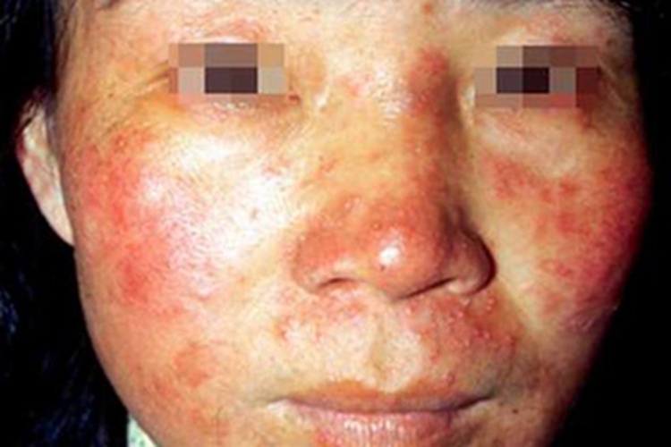 蠕形螨病面部红斑图