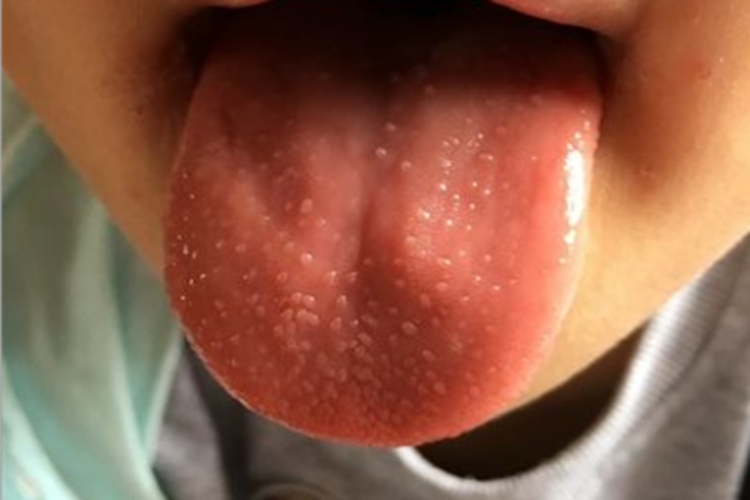 萎缩性舌炎舌头疙瘩图