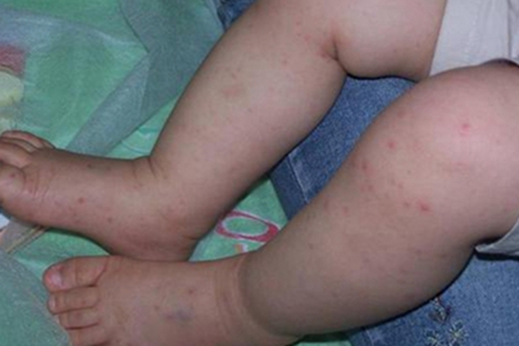 手足口病腿部红点图