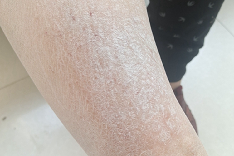 慢性湿疹小腿干燥粗糙图