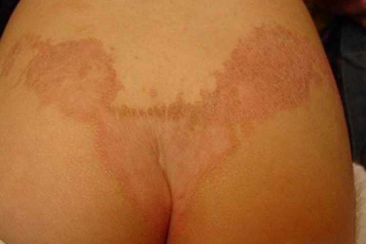 毛发红糠疹性红皮病臀部丘疹图
