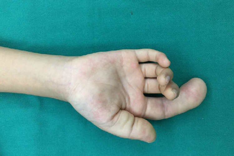 巨指症图 巨指症图