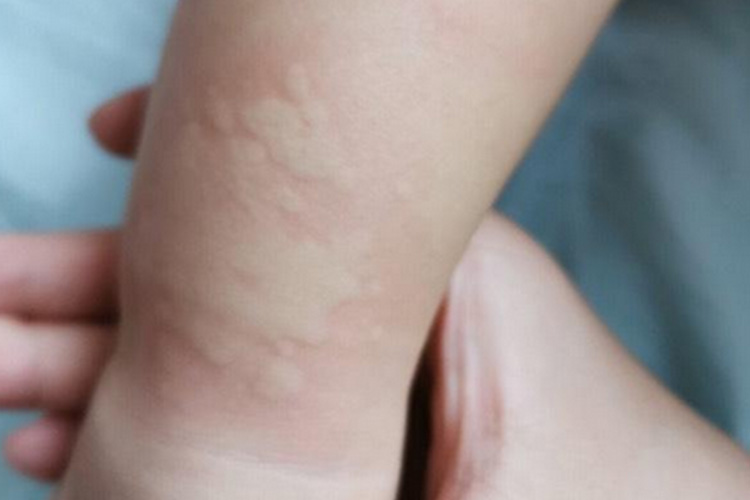 轻微小儿荨麻疹图 轻微小儿荨麻疹图