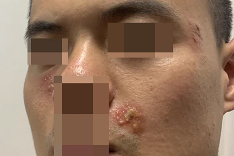 单纯疱疹面部症状图