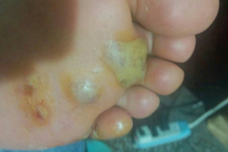 深脓疱疮脚底大疱图 深脓疱疮脚底大疱图