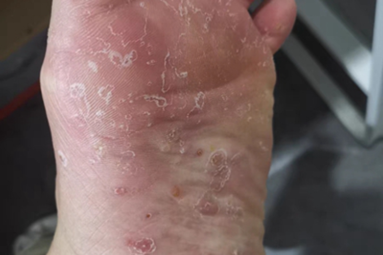 水疱型足癣脚底有水疱脱屑图
