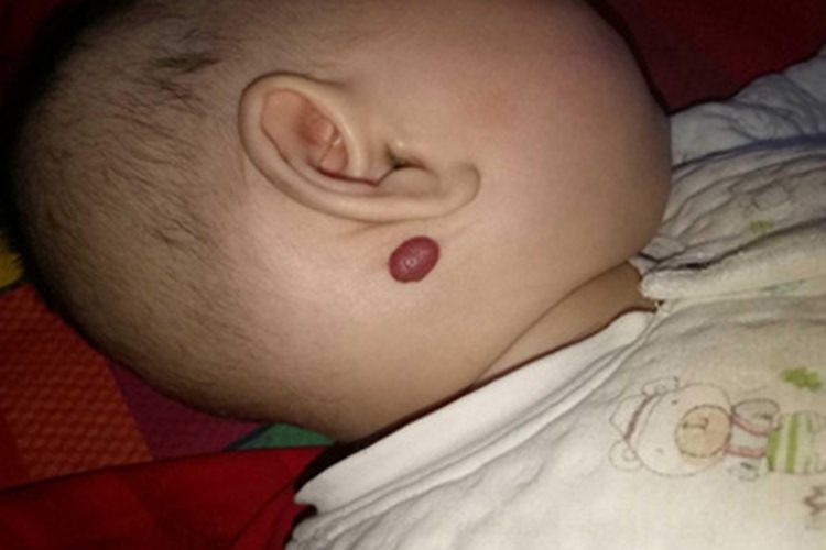 血管瘤耳周软疙瘩图