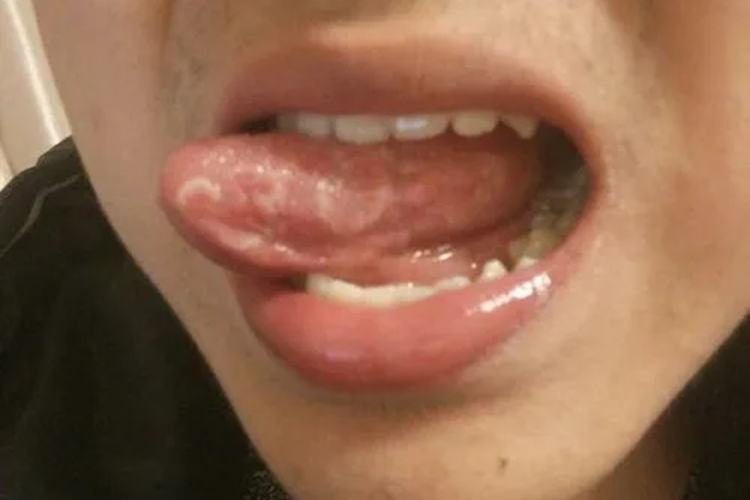 口腔扁平苔藓舌两侧白色条纹图