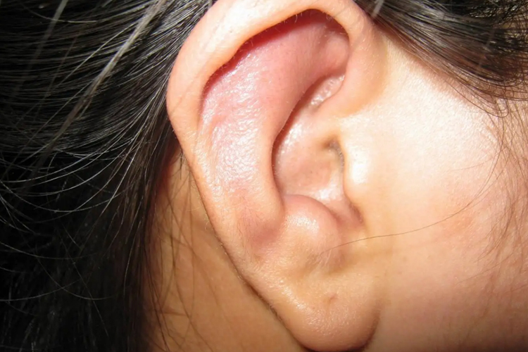 化脓性软骨膜炎早期图