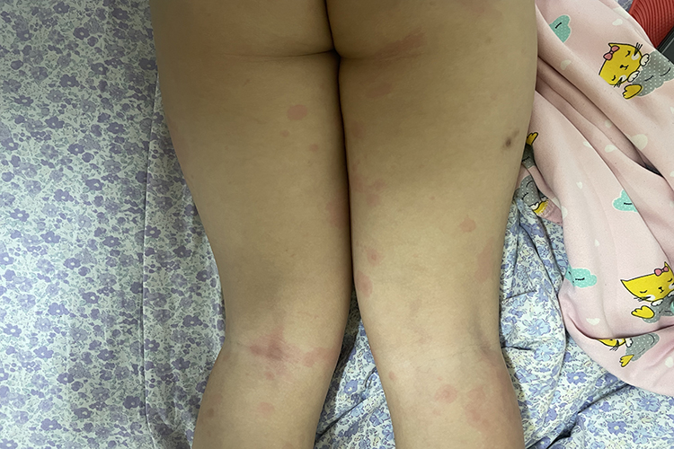 胆碱能性荨麻疹图