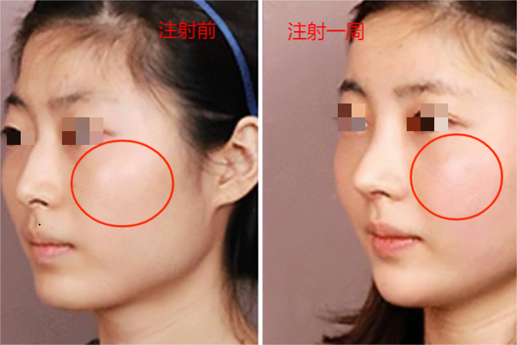 苹果肌脂溶针一周的效果图