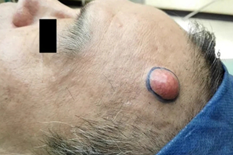 毛发囊肿肿块图 毛发囊肿肿块图