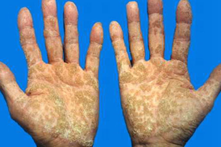 弥漫性掌跖角皮症手掌增厚黄痂图 弥漫性掌跖角皮症手掌增厚黄痂图
