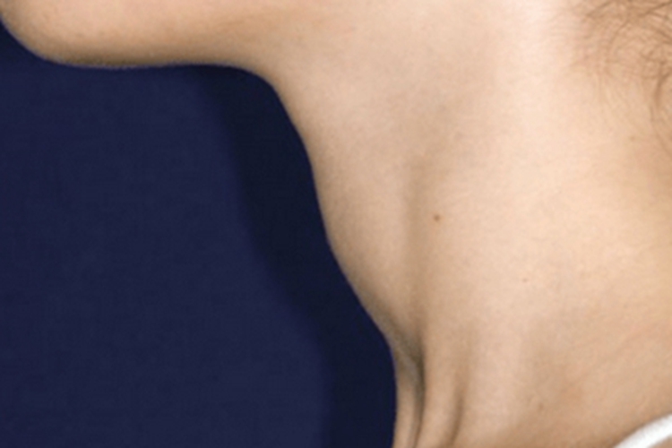 结节性甲状腺肿颈部侧面小疙瘩图