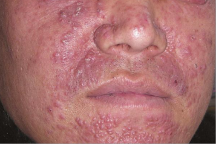 颜面粟粒性狼疮面部结节图