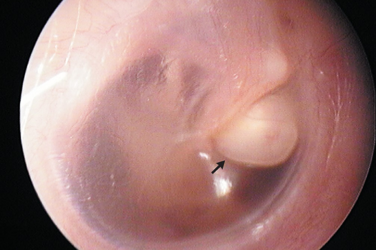 外耳道胆脂瘤白色瘤体图