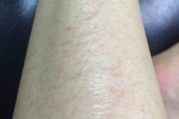 特发性网状青斑症状图