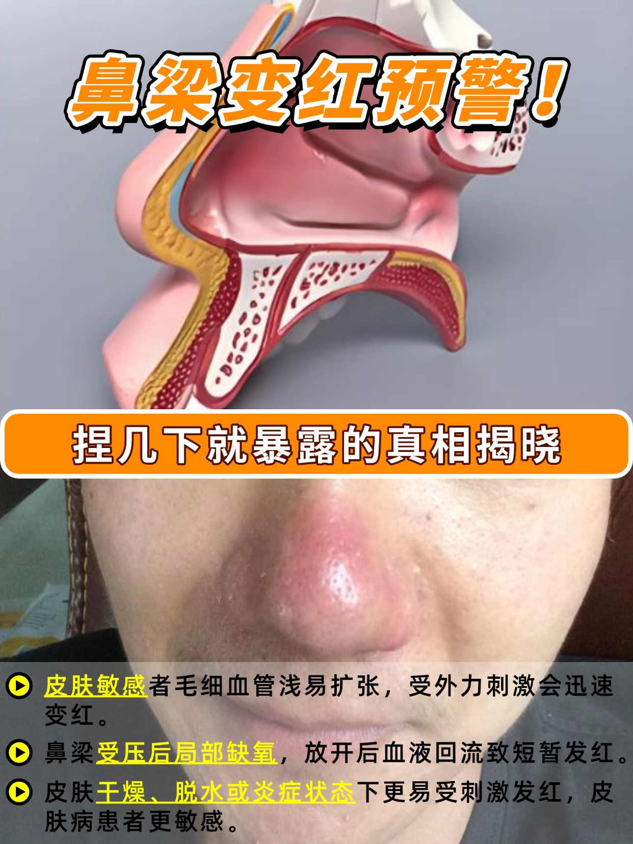 鼻梁变红预警!捏几下就暴露的真相揭晓
