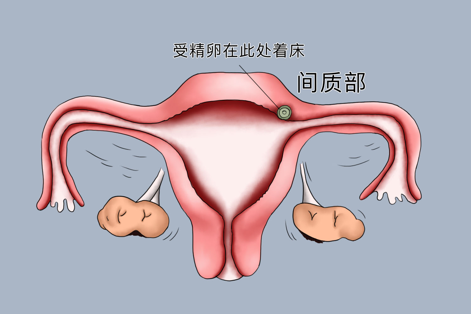 间质部妊娠图 间质部妊娠图