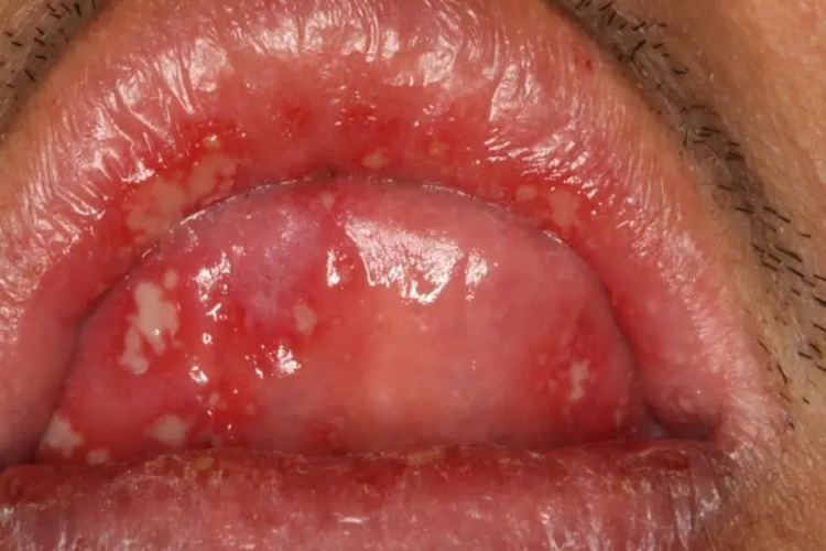 疱疹型复发性阿弗他溃疡图 疱疹型复发性阿弗他溃疡图