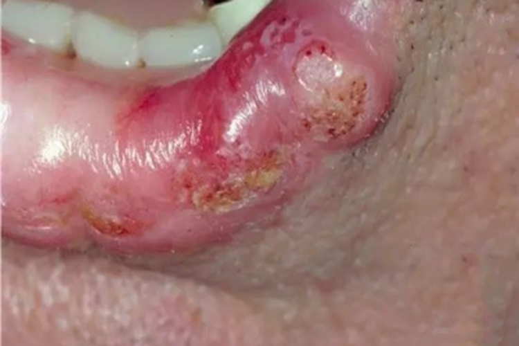 急性光线性唇炎症状图