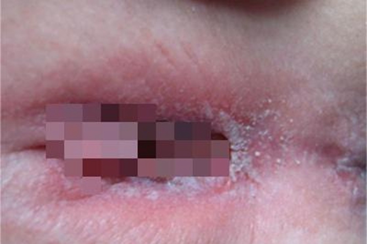 外阴阴道念珠菌病红肿图