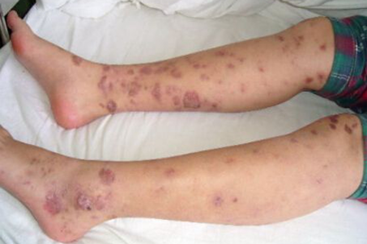 白塞病结节性红斑样图