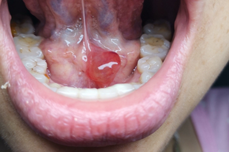 涎腺囊肿疙瘩图