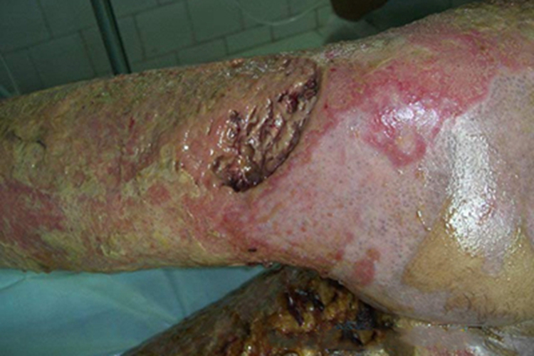 三度烫伤大腿症状图