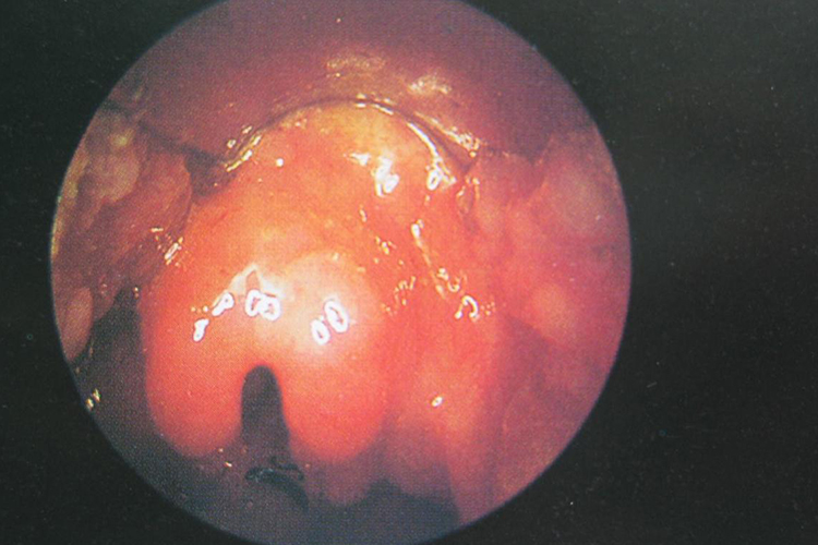 会厌息肉的症状图片图片