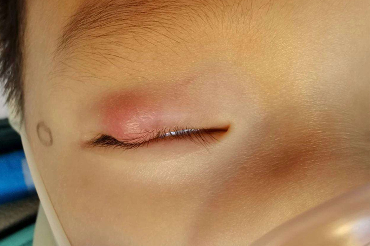 眼睛长撅眼初期的图片