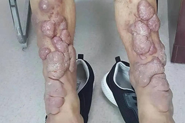 胫前黏液性水肿小腿结节图