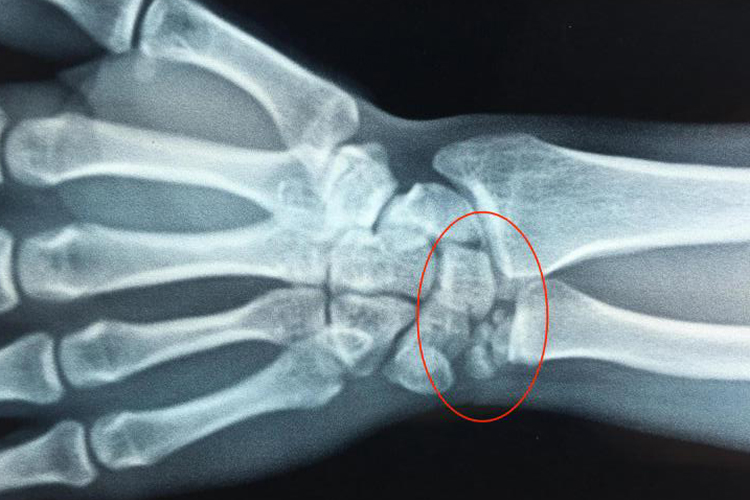 手腕三角软骨损伤图