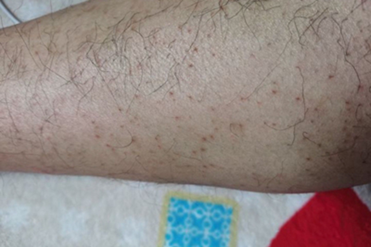 色素性紫癜性皮病小腿血点图