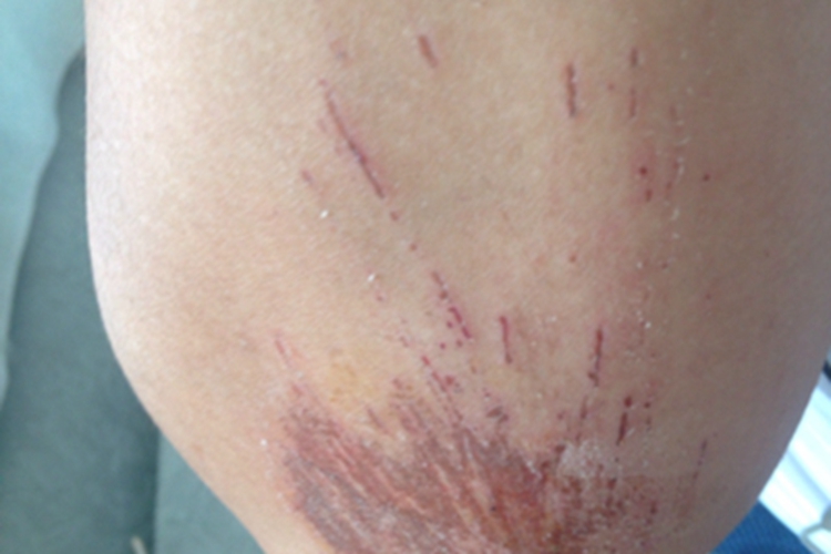 擦伤肘部血痂图