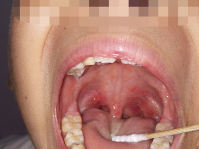 疱疹性咽峡炎嗓子图片图片